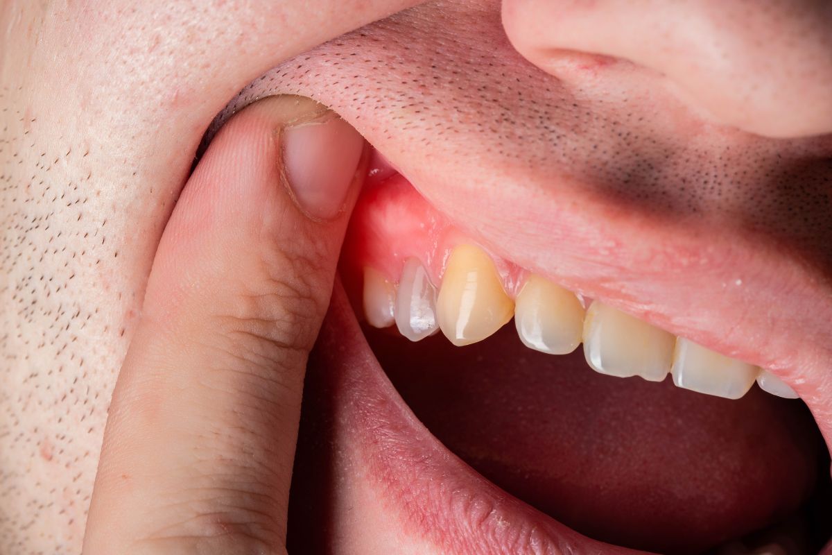 Gum Disease