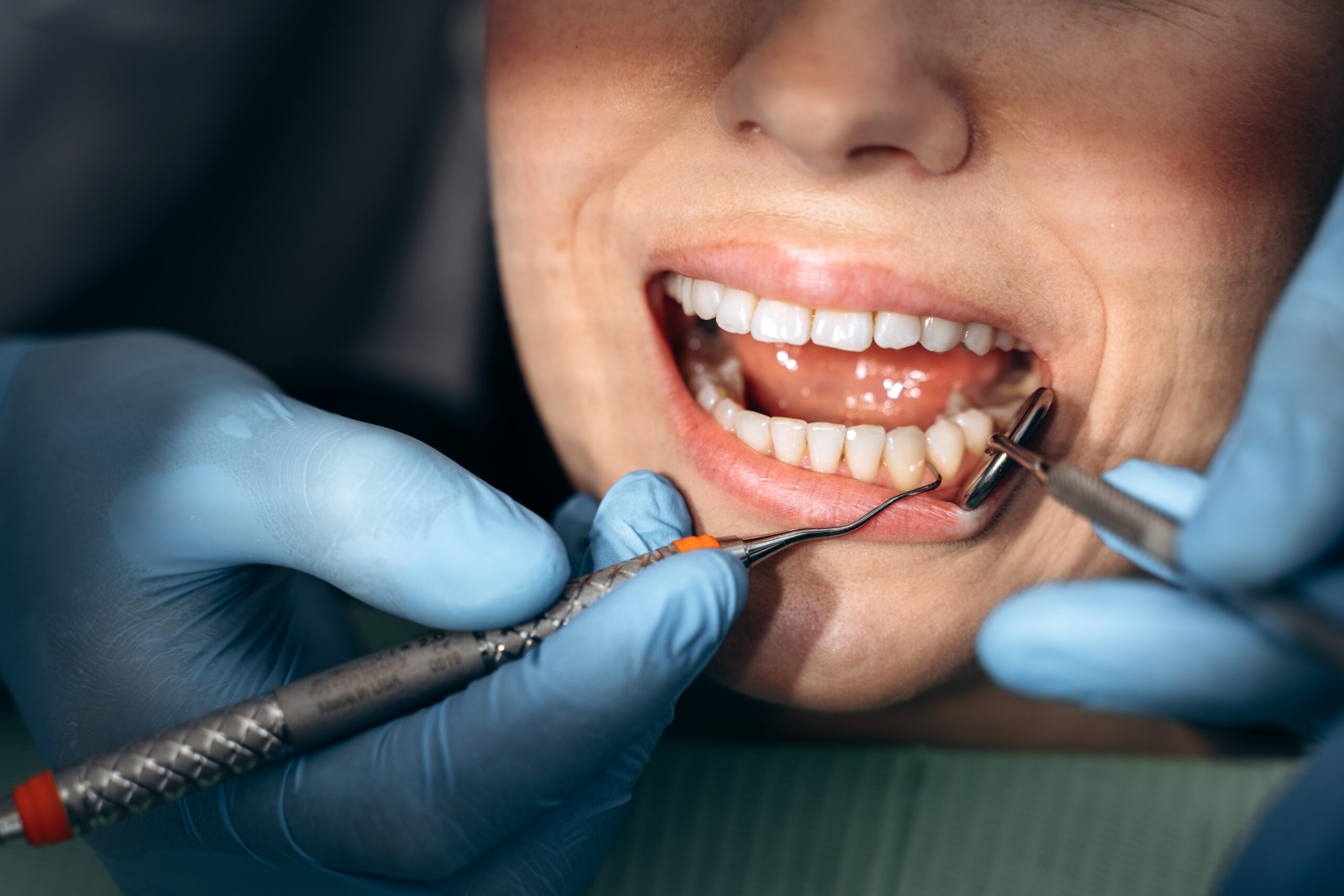 Bad Oral Hygiene Really Lead to Oral Cancer