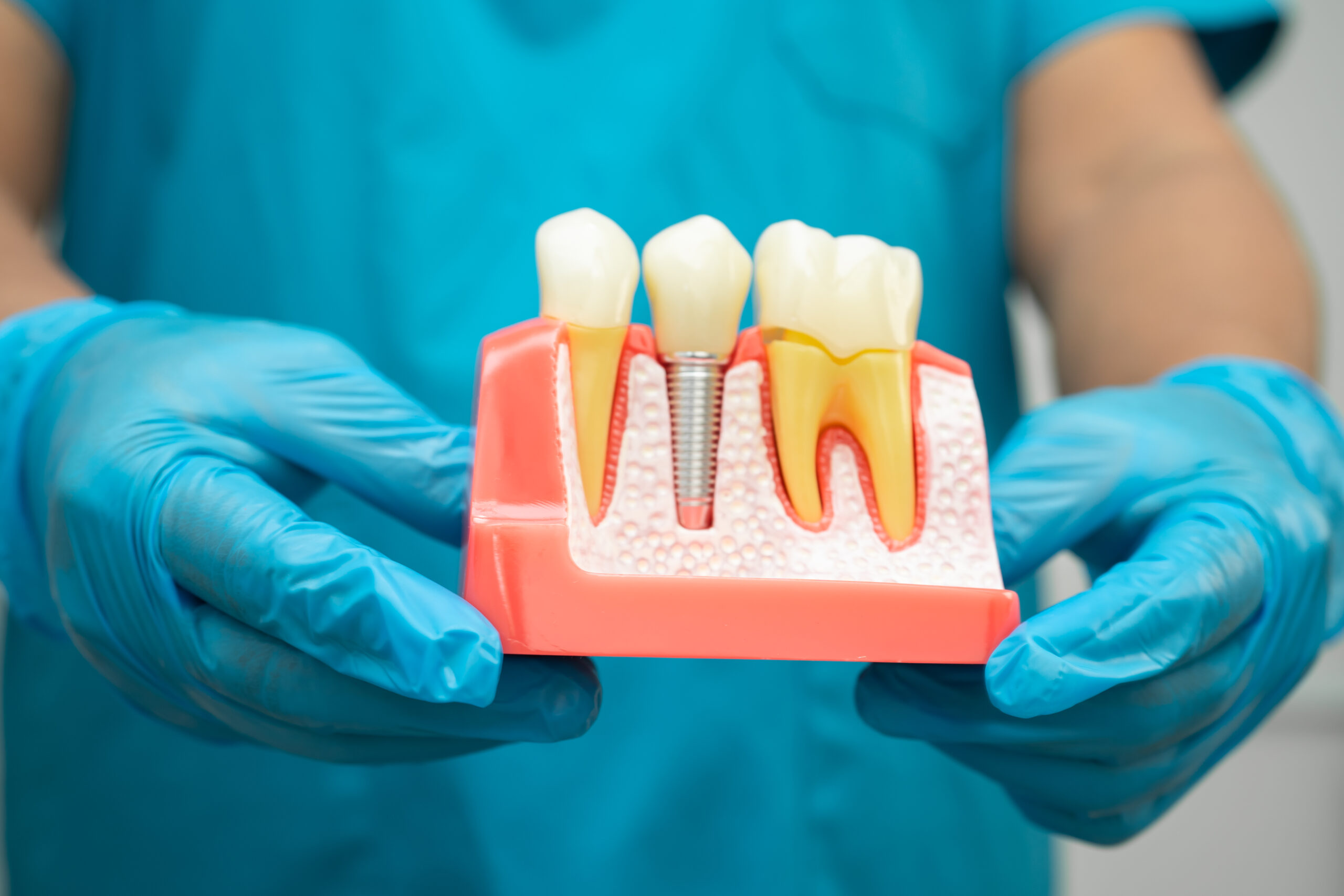 dental implants in red bank