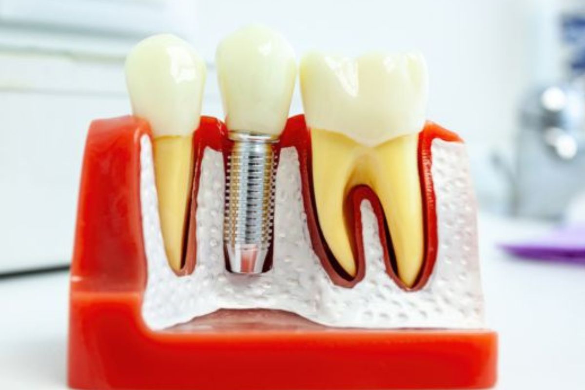 dental implants