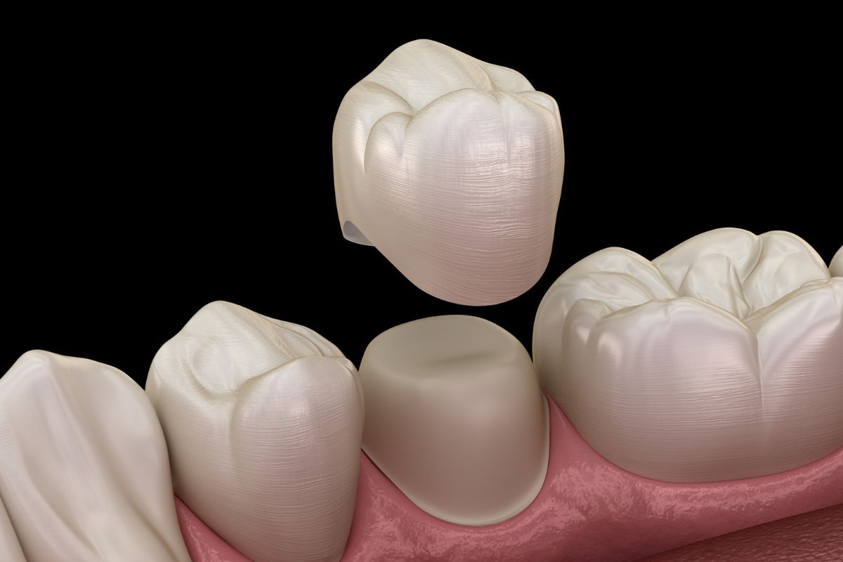 dental crown