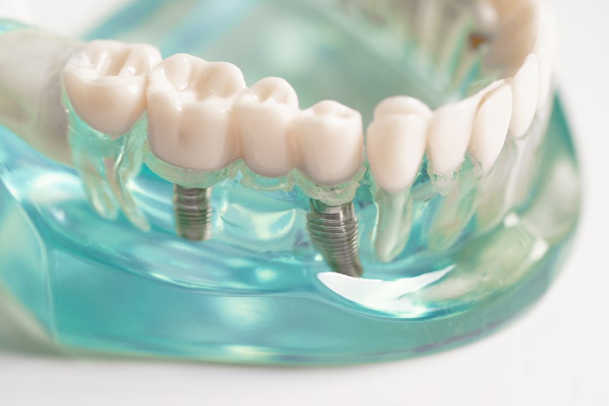 2 Dental Implants Next To Each Other