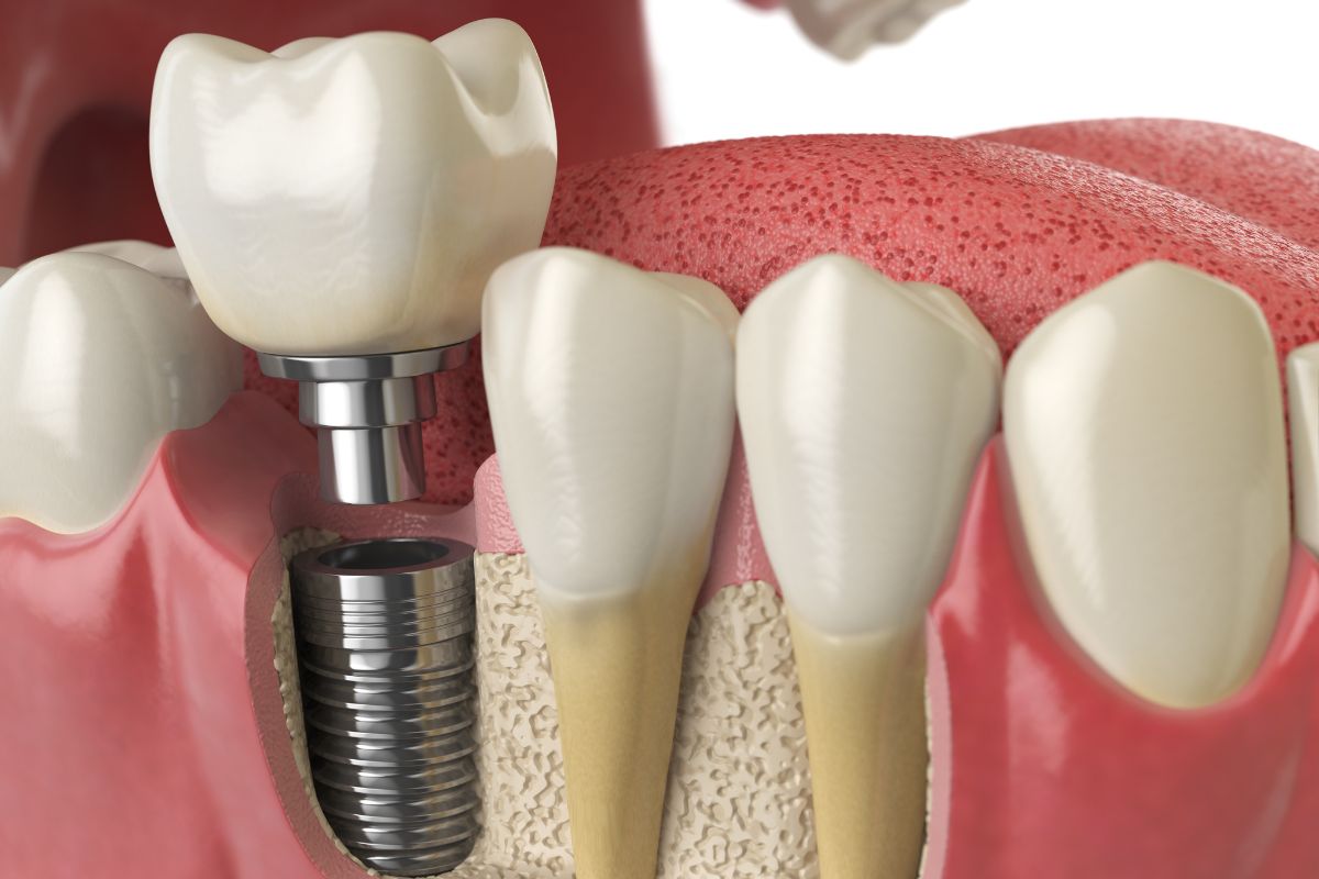 How Many Teeth Can Dental Implants Replace