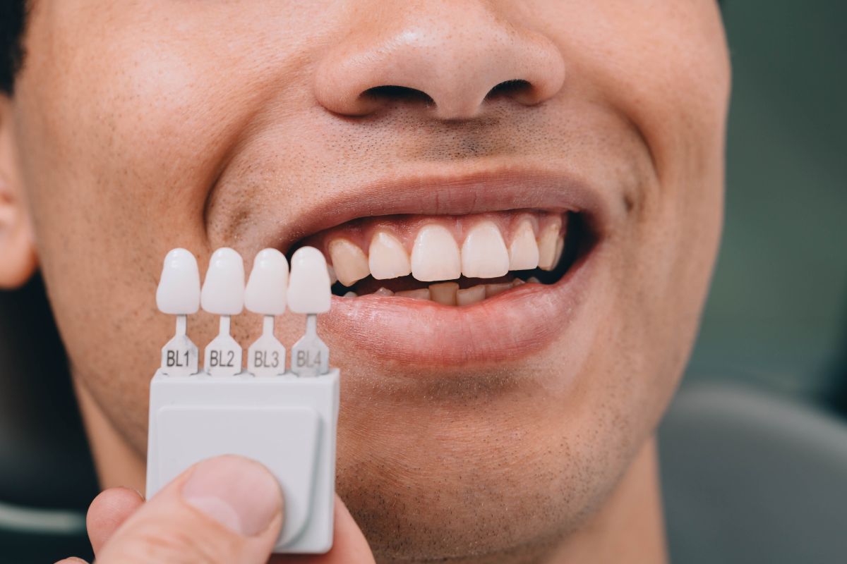 dental lumineers