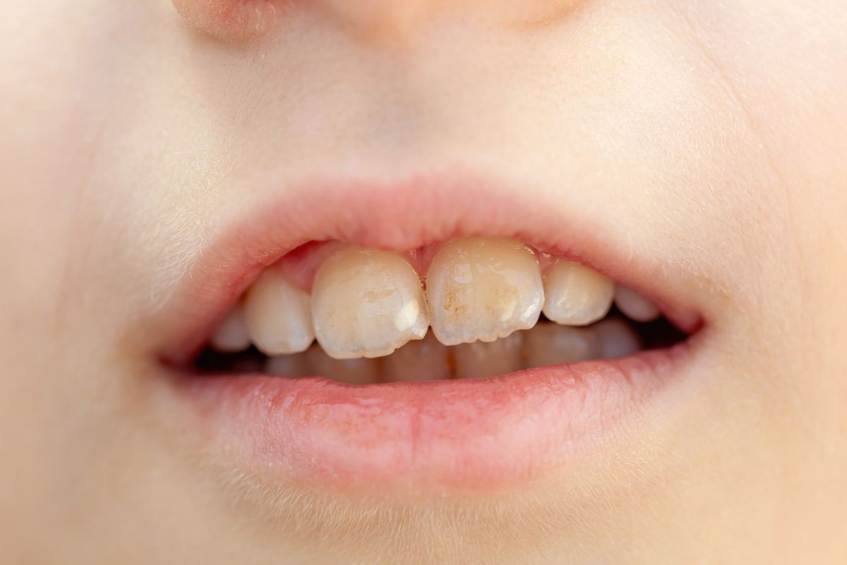 white spots on teeth's