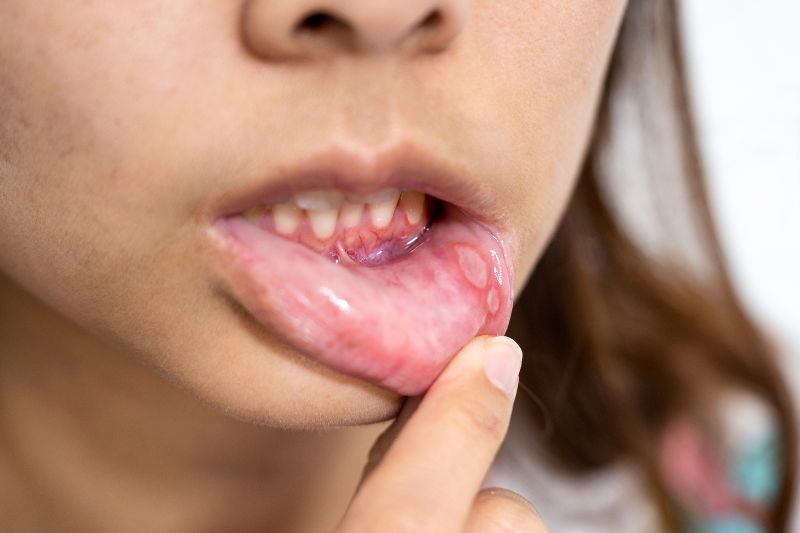 Canker Sores on Gums