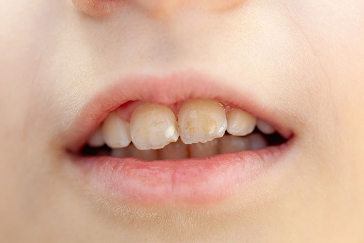 dental Mamelons