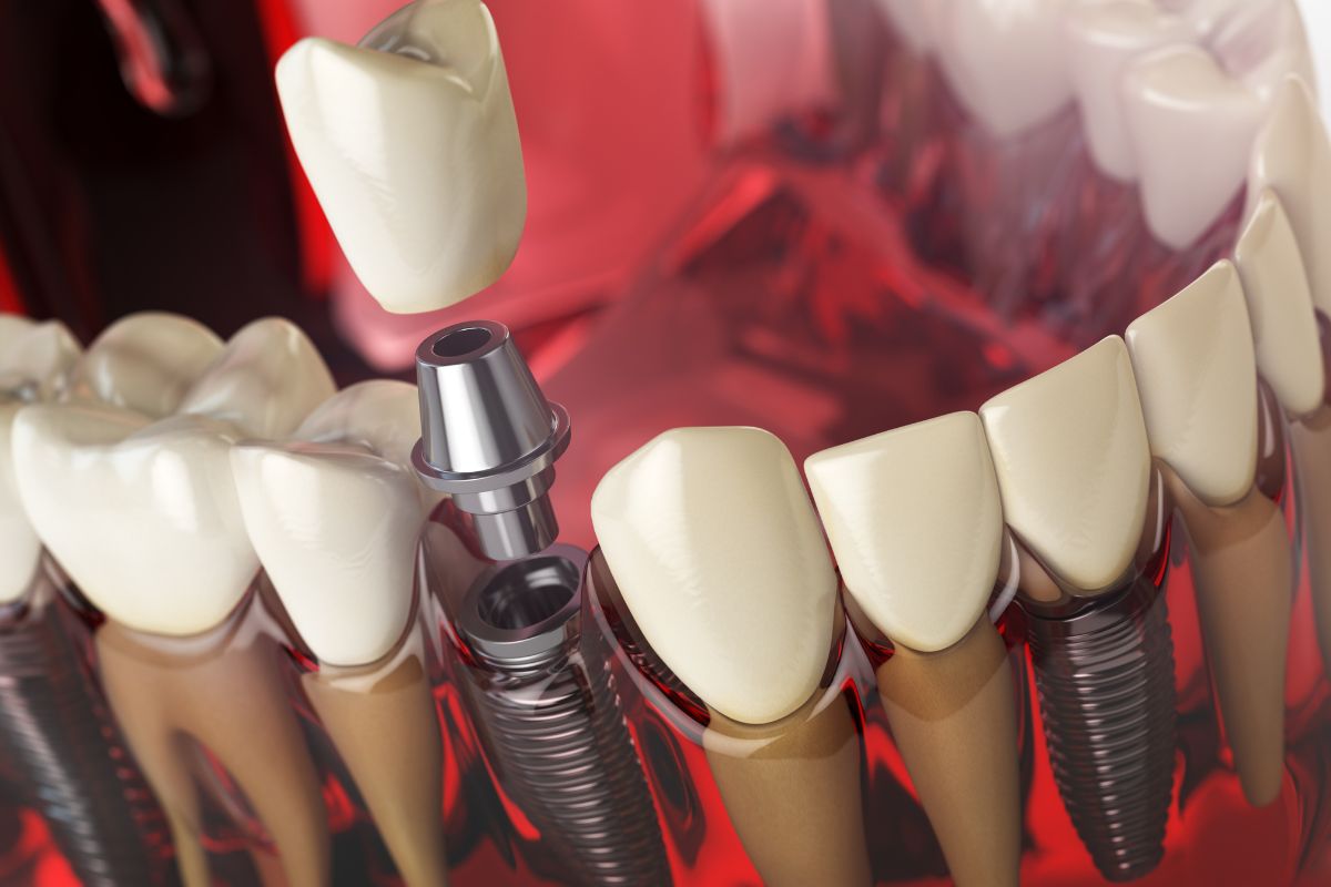 dental implants