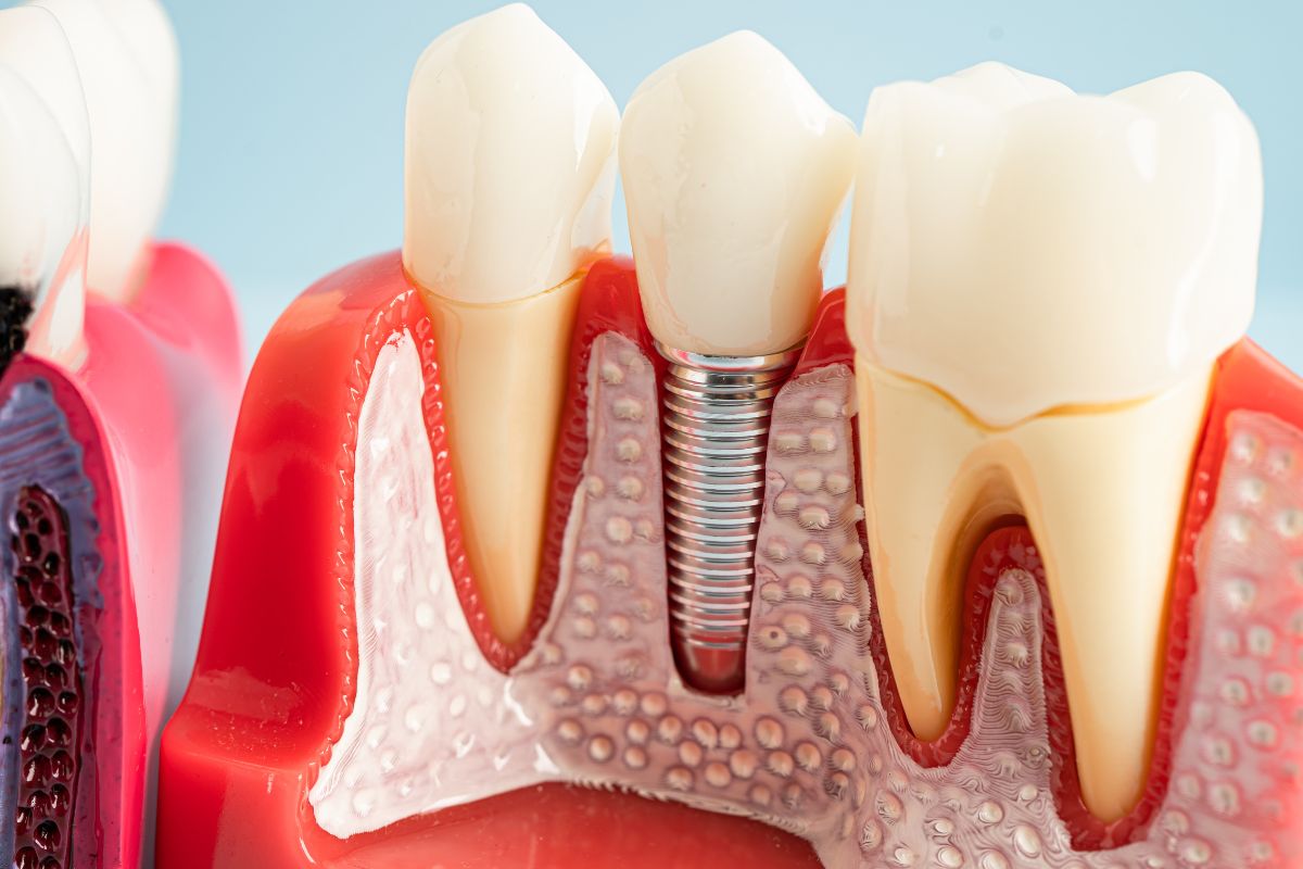 Dental Implants After Losing a Tooth