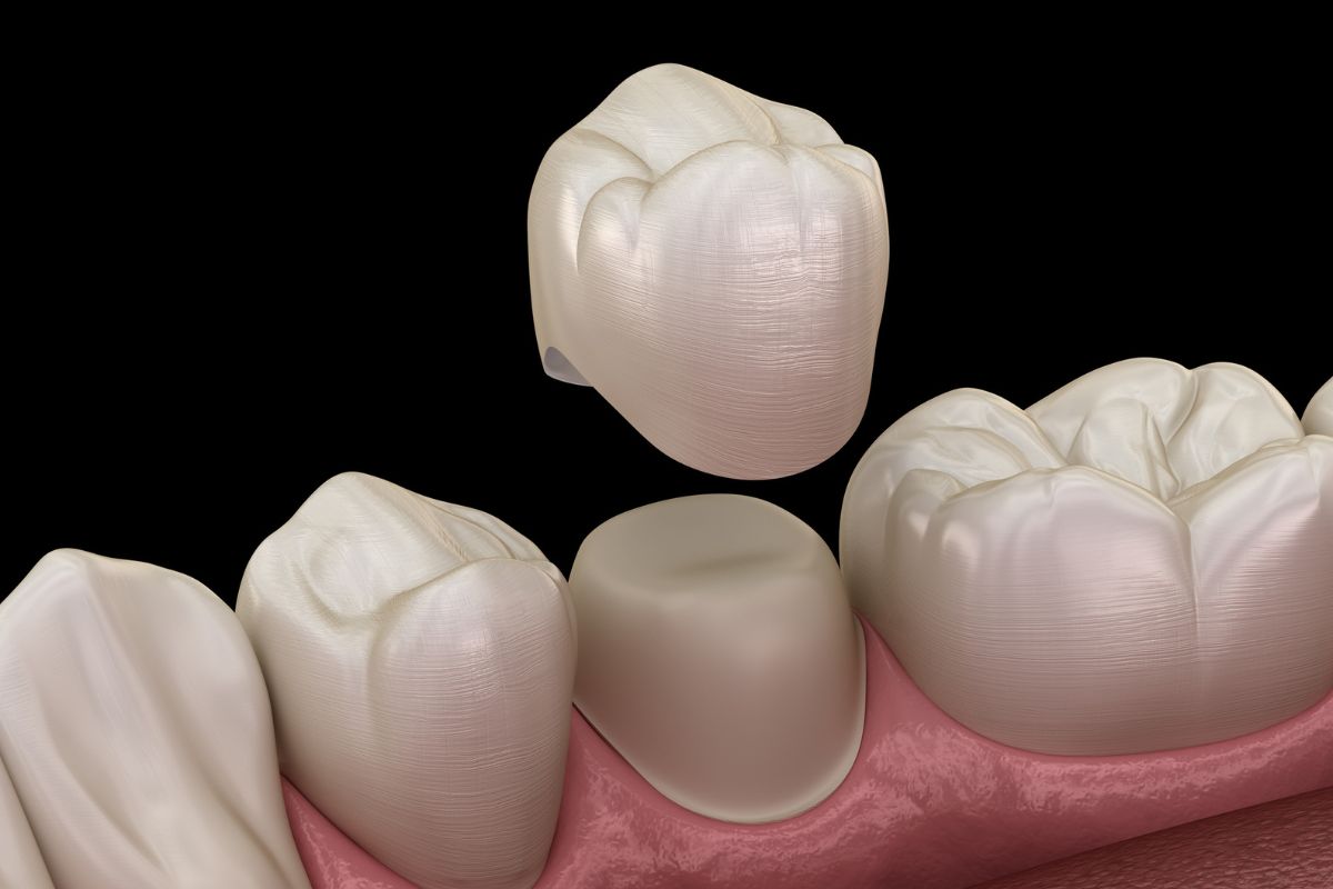 Do Dental Crowns Last 10 or 20 Years