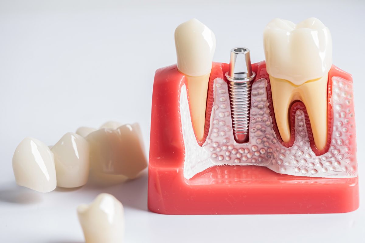 Rid of a Lisp After Dental Implants