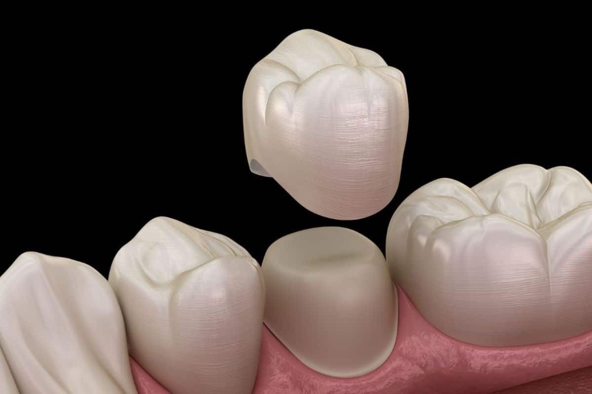 Close-up illustration of dental crown placement showing natural tooth color match and gum integration.