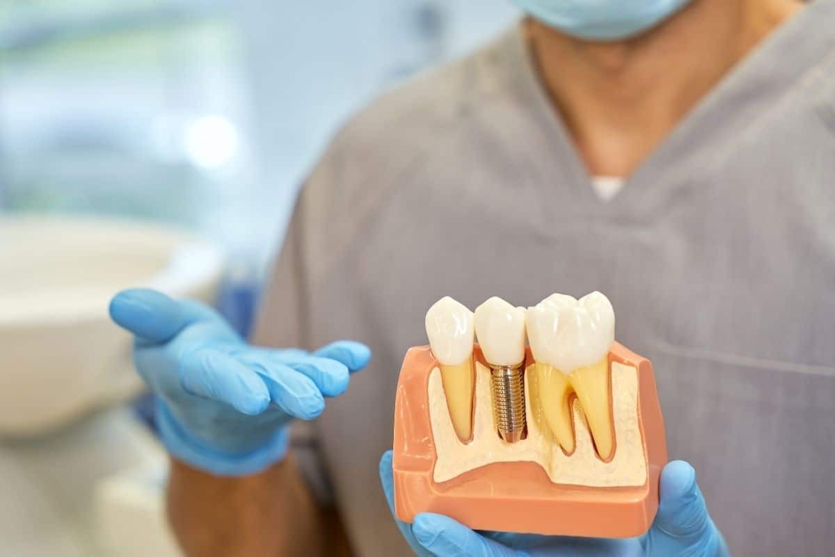 Dental implant model showing bone graft placement and tooth restoration procedure in Bel Air.