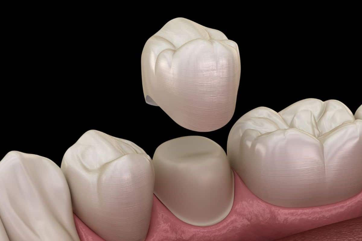 Cavity Under a Dental Crown